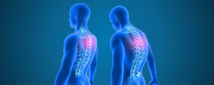Bad Posture Syndrome: Signs, Causes and Everyday Habits That May Help