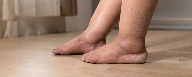 Body Swelling Explained: What Your Symptoms Might Indicate