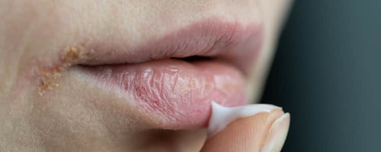 Seasonal Changes and Lip Dryness: What You Should Know