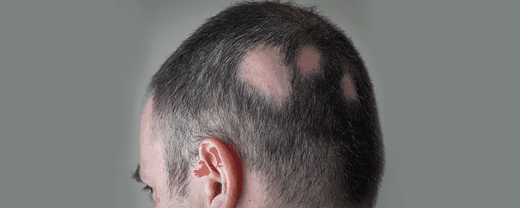 alopecia-what-are-the-causes-and-its-treatment