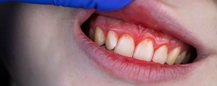 Celebrity Dental Secrets You Didn't Know Help Prevent Pyorrhea