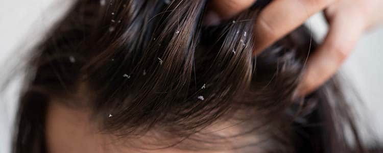 Dandruff in Kids, Causes and Cures