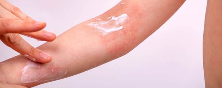 Eczema Care in Indian Climate: Gentle Homoeopathic & Lifestyle Tips