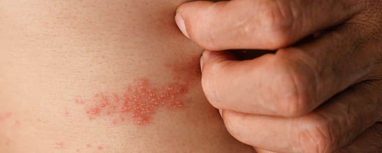 Fungal vs Bacterial Skin Infections: What to Know