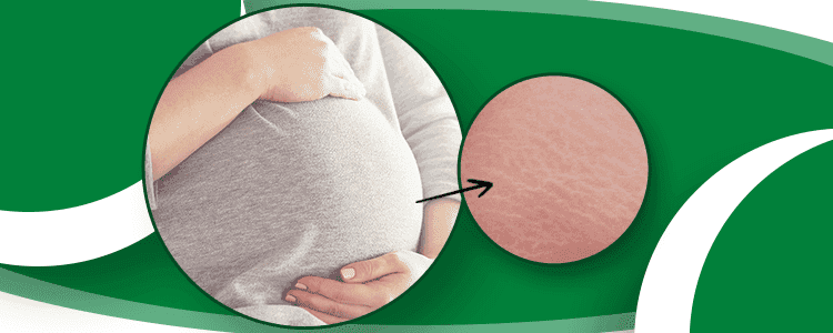 Get Rid from stretch marks post delivery
