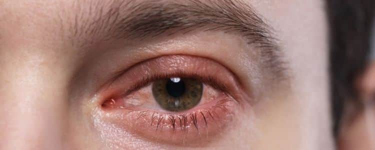 How Eye Flu Spreads and How to Stop It Before It Starts
