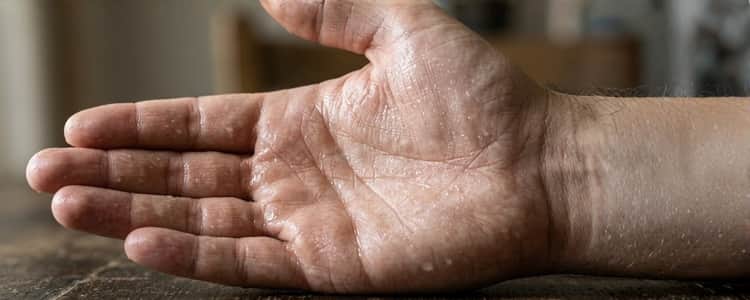 Managing Sweaty Palms and Feet: Practical Tips for Daily Comfort