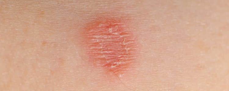 Ringworm Relief: The Ultimate Guide to Homeopathic Solutions