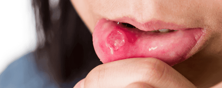 Ulcers on Mouth and Lips Causes, Risk Factors, and Remedies
