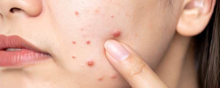 Understanding Seasonal Acne: Why Skin Behaves Differently in Winter