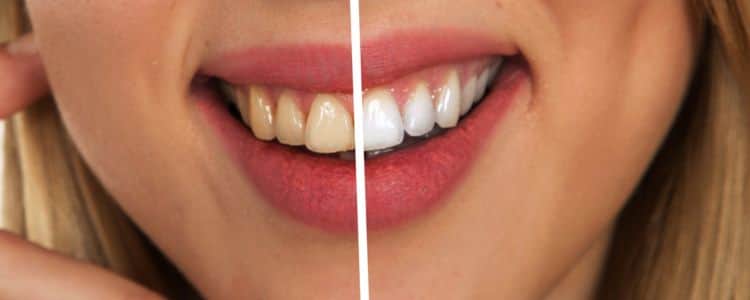 Why Do Teeth Turn Yellow? Top Causes and How to Fix Them Naturally