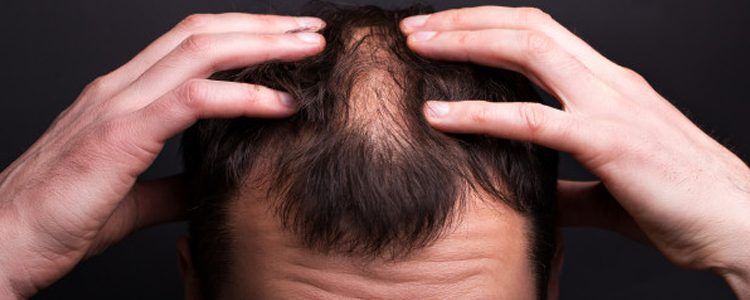 Alopecia Areata - Patchy Hair Loss: Causes, Symptoms & Homeopathic Remedies